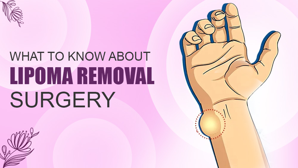 What to Know About Lipoma Removal Surgery