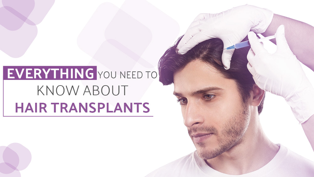 Everything You Need to Know About Hair Transplants