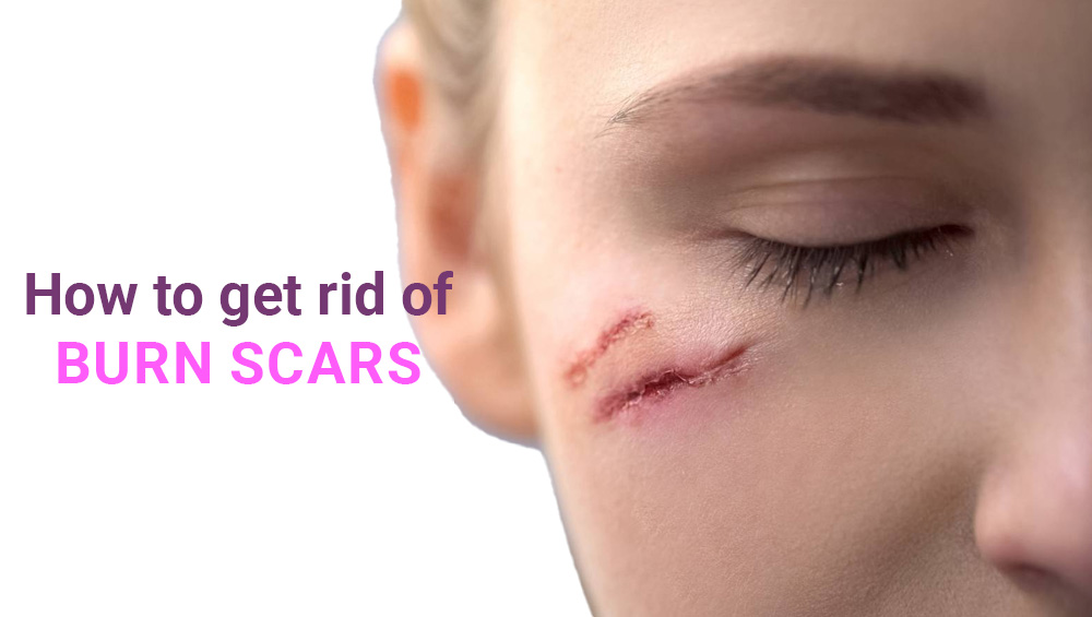 How to Get Rid of Burn Scars