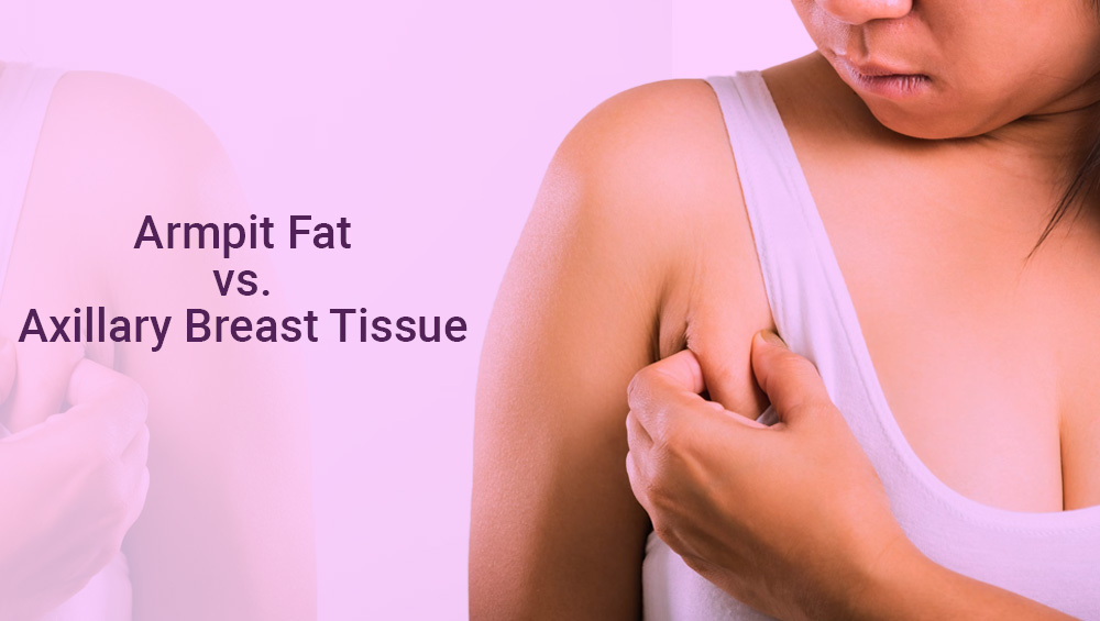 Armpit Fat vs. Axillary Breast Tissue
