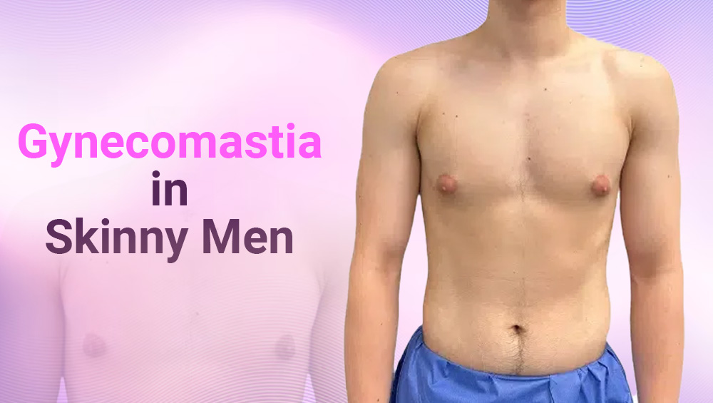 Gynecomastia in Skinny Men