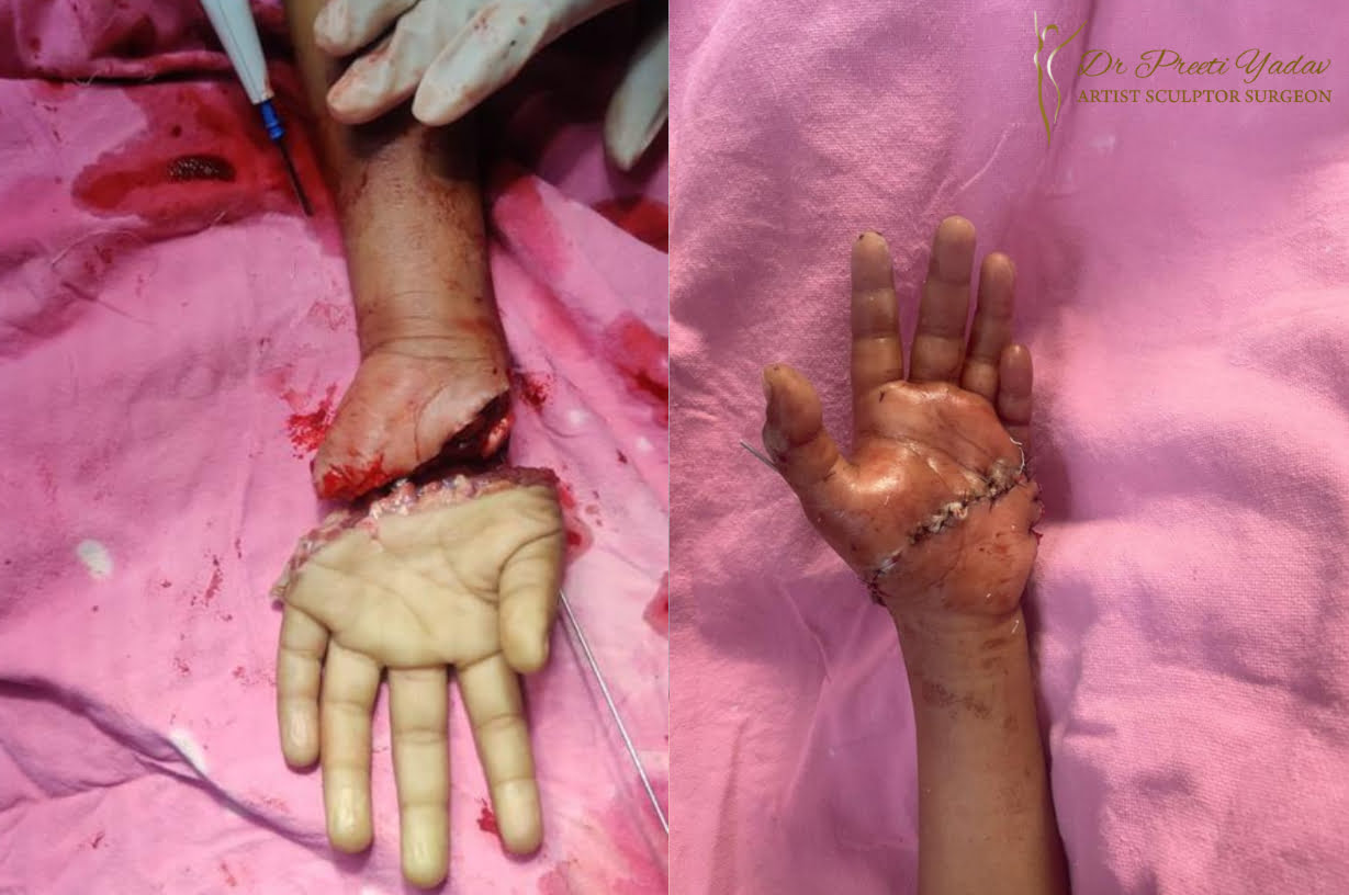Hand Reimplant surgery