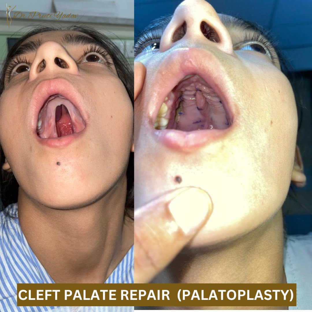 Cleft Palate Repair (Palatoplasty)