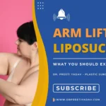 arm liposuction surgery in Gurgaon
